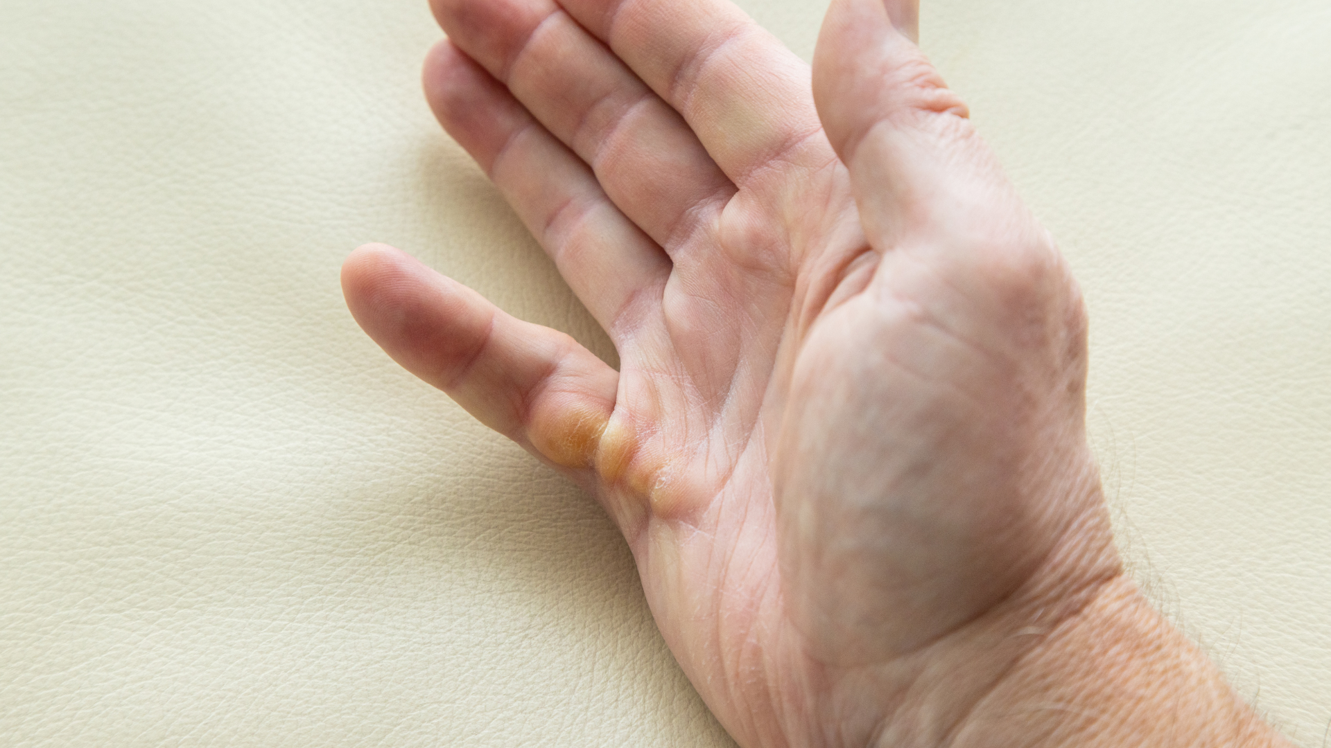 dupuytren's contracture specialist boise